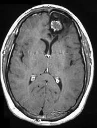 Difference between tumor and cancer, CT scan